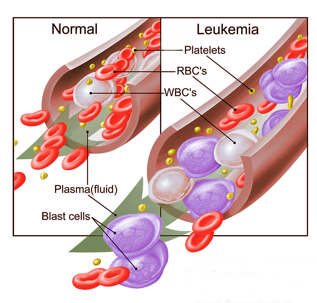 Normal Blood Cells and Leukaemia