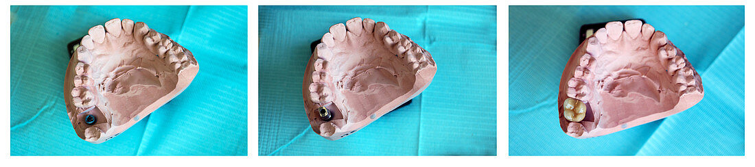 Permanent Implants, Sequence, dental
