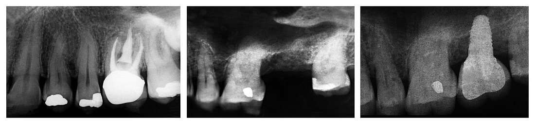 3 Stages in the life of a tooth, X-Rays