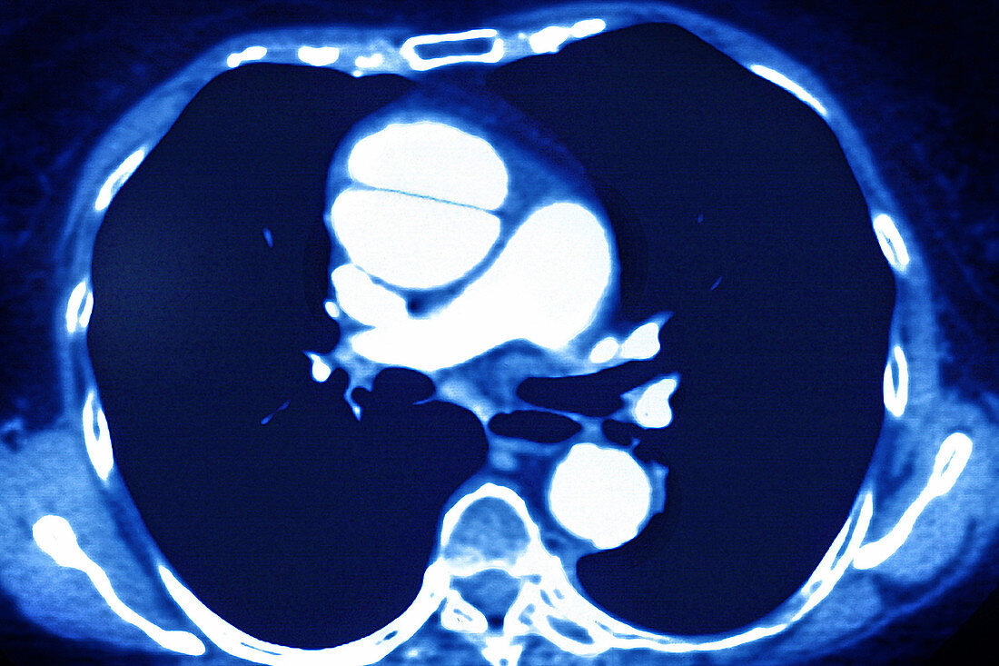 Aortic dissection, CT MRI