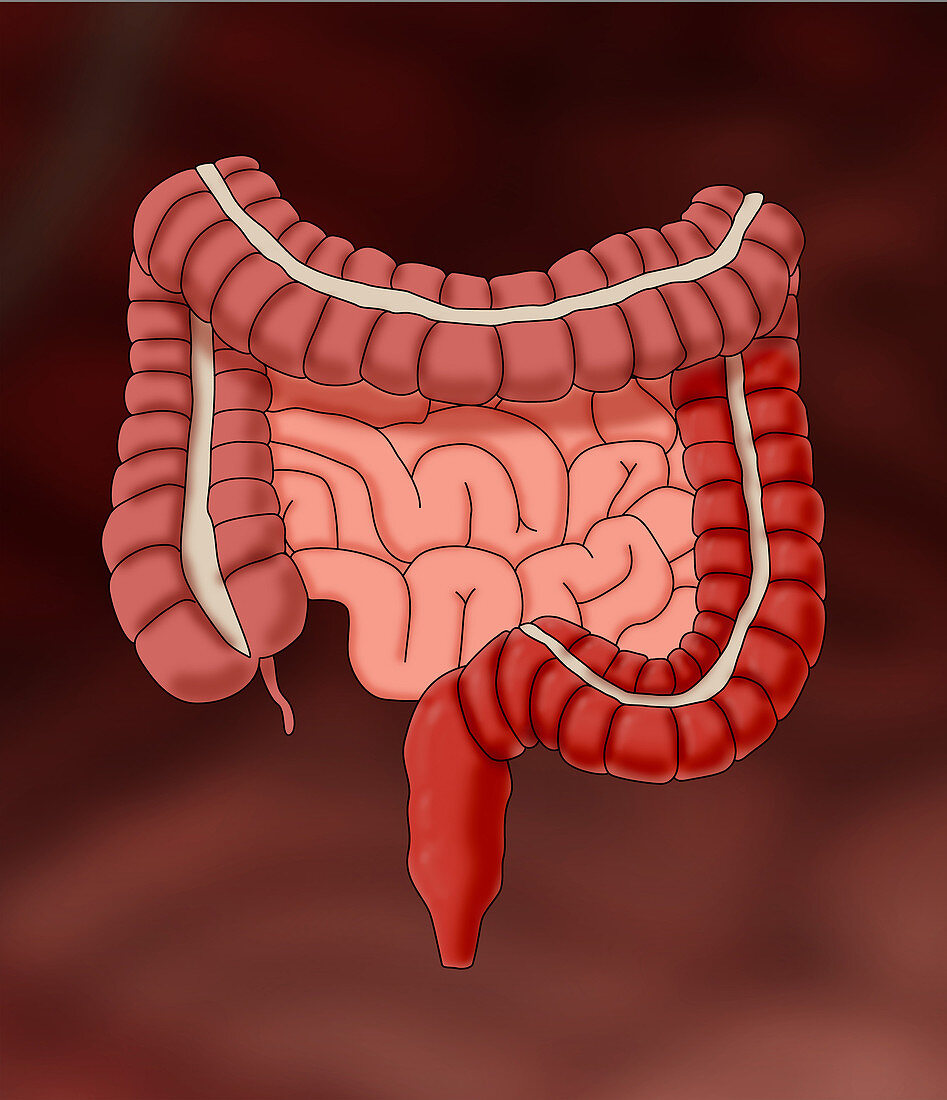Ulcerative Colitis Typical Location, Illustration