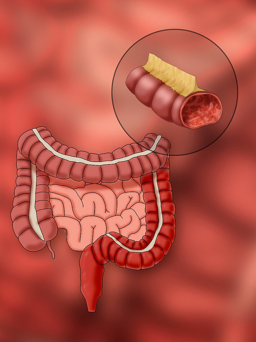 Ulcerative Colitis, Illustration