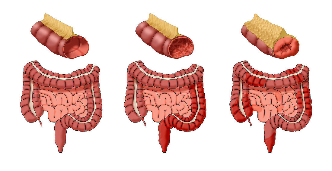 Healthy, Colitis & Crohn's Disease, Illustration