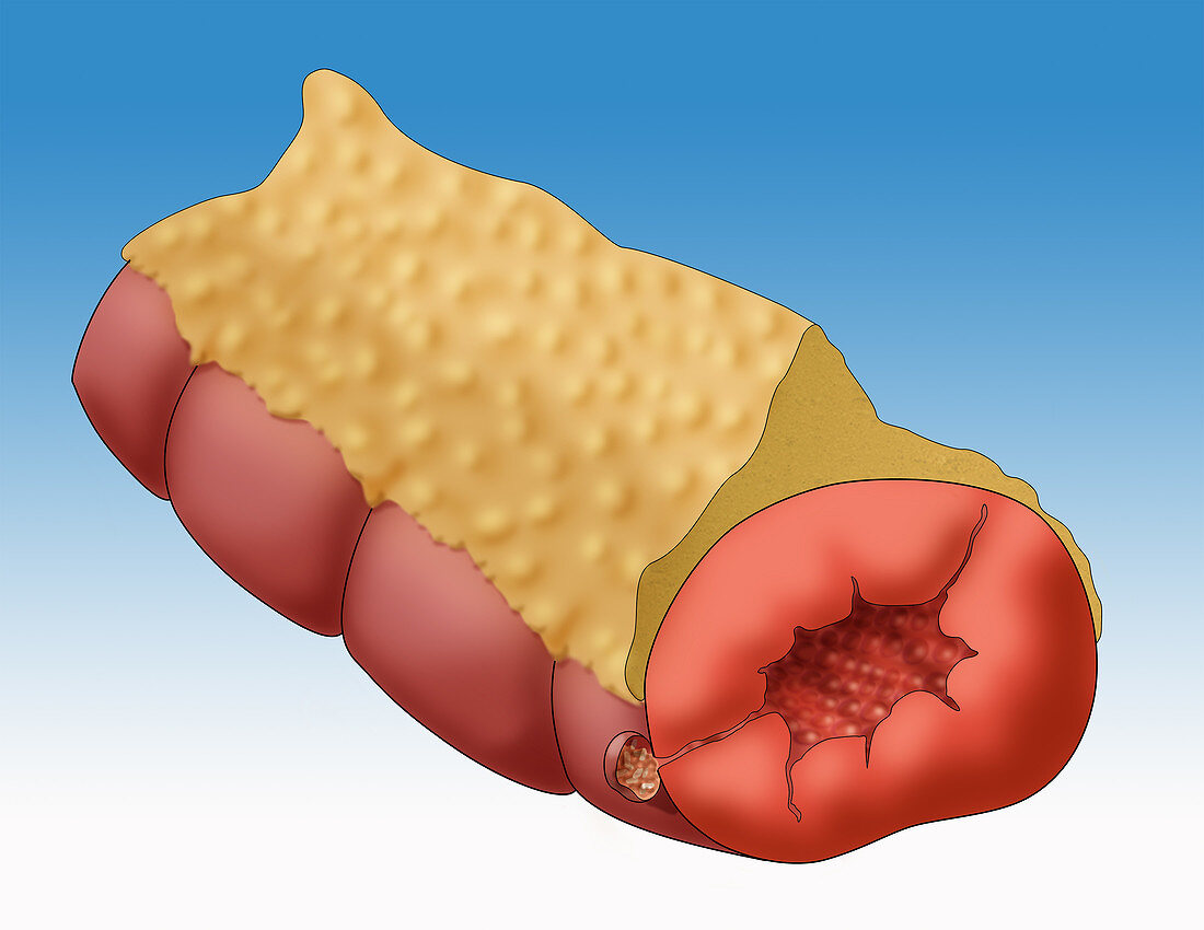 Crohn's Disease, Illustration