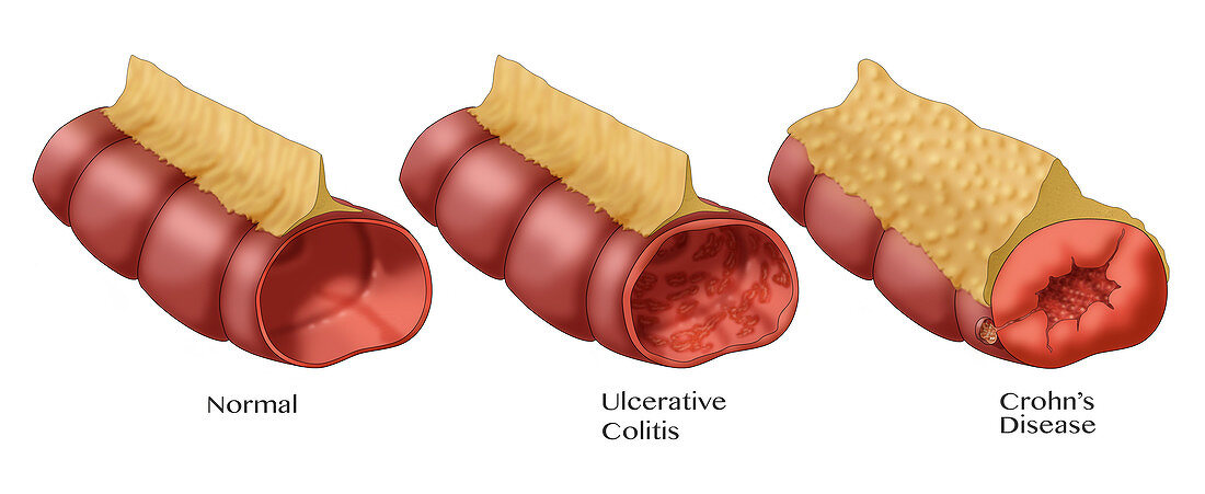 Healthy Intestine, Colitis & Crohn's Disease