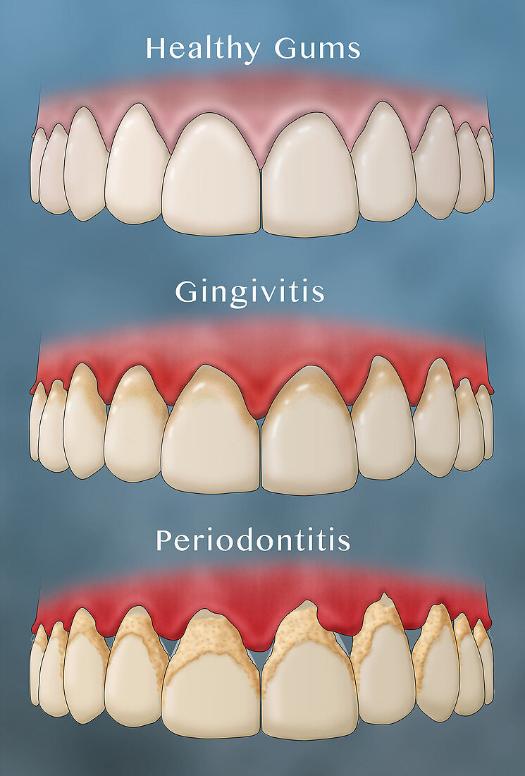 Progression of Gum Disease, Illustration