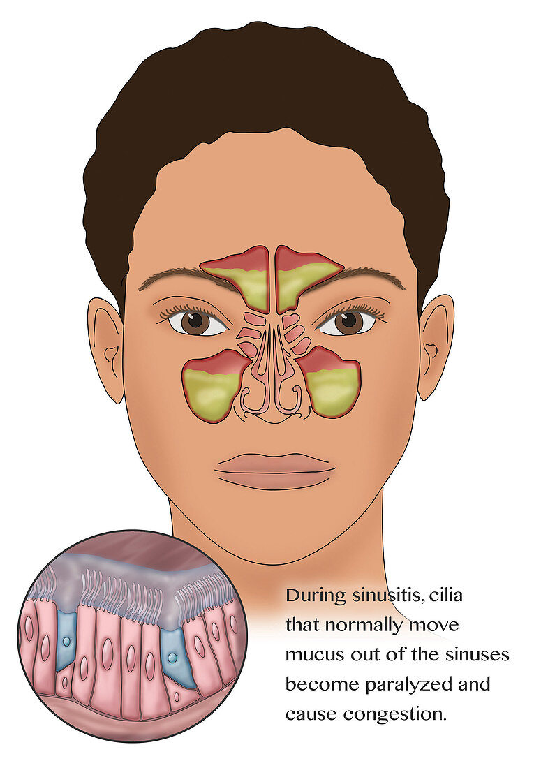 Sinusitis, Illustration