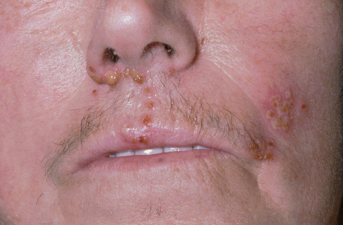 Herpes: eczema