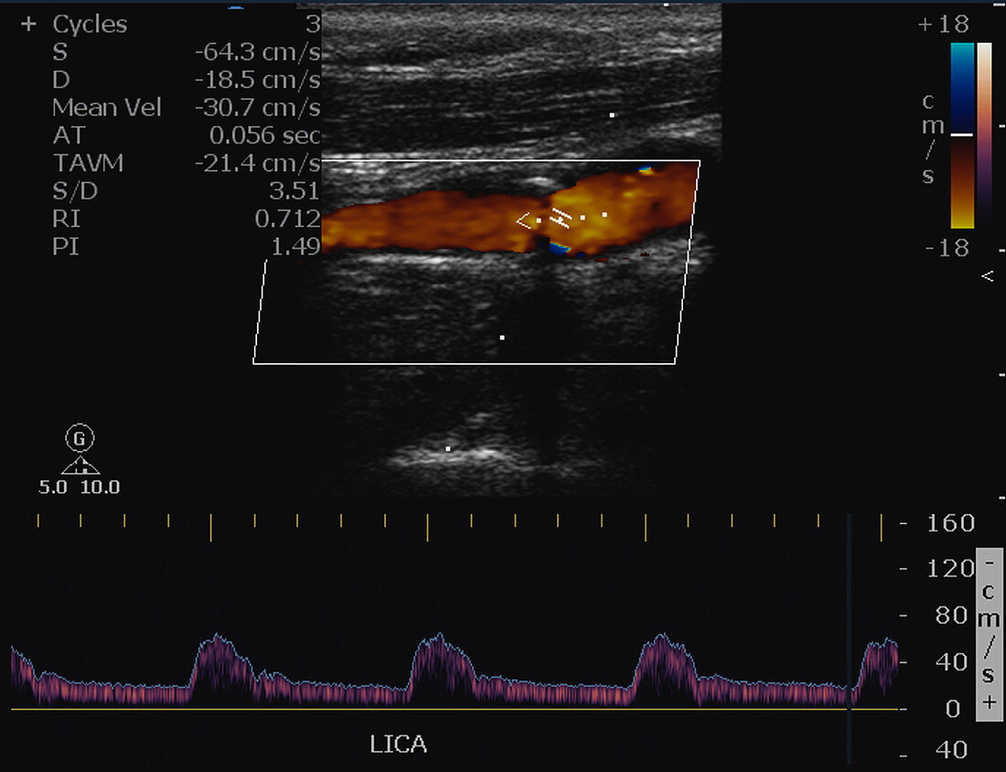 Mild LT ICA Stenosis, Doppler Ultrasound