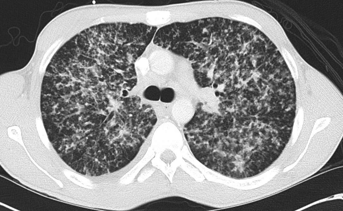 Aspergillosis, CT scan