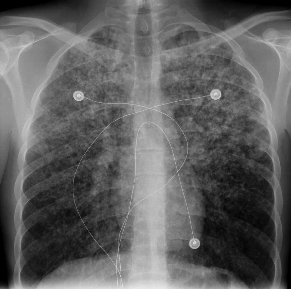 Aspergillosis, X-ray