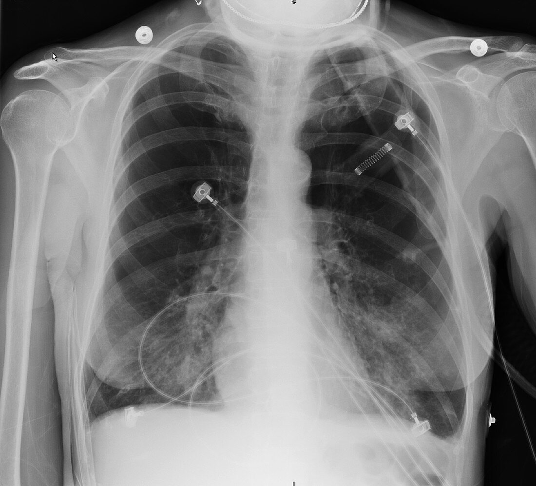 COPD, X-ray
