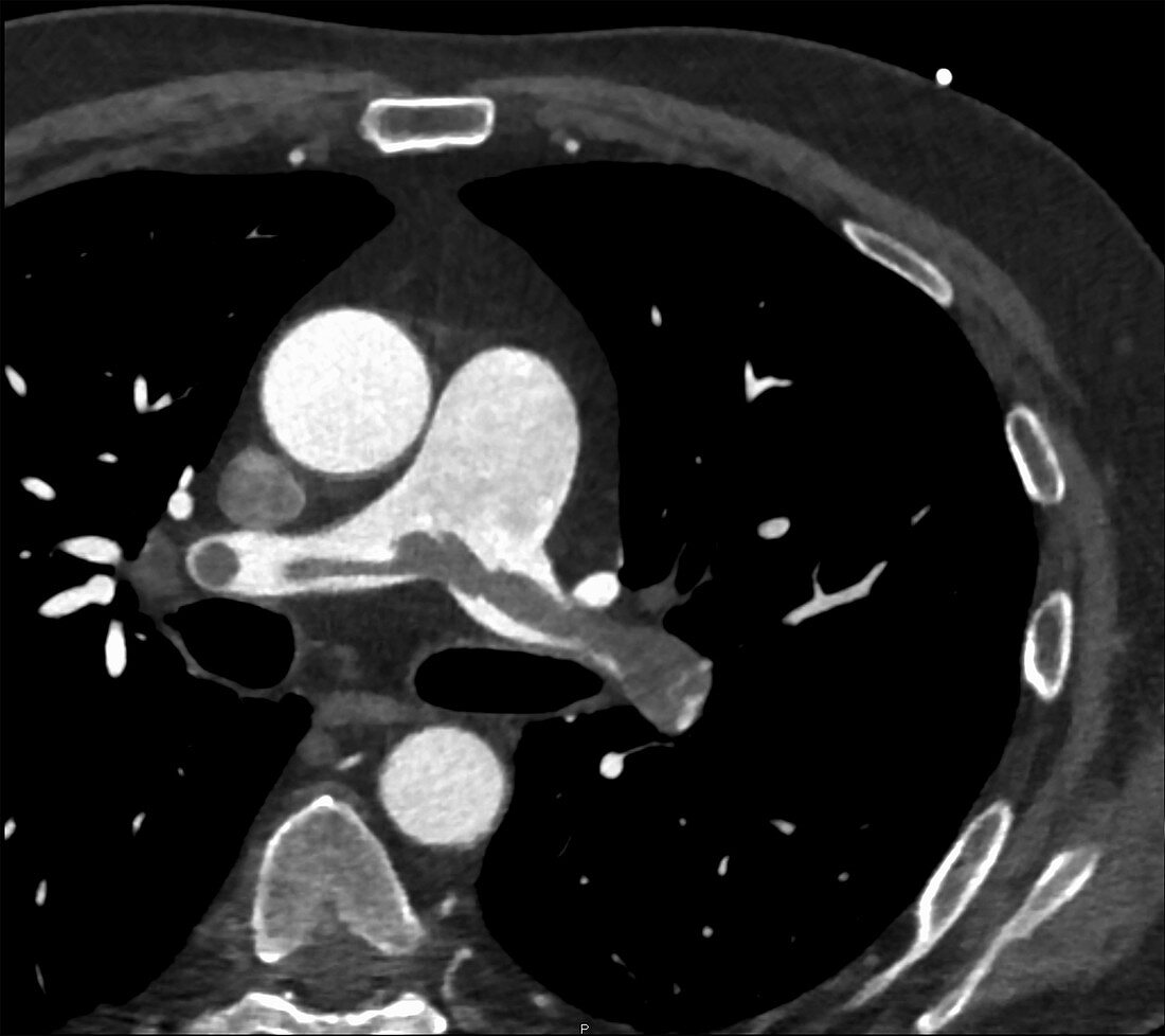 Pulmonary thromboembolism, CT angiogram