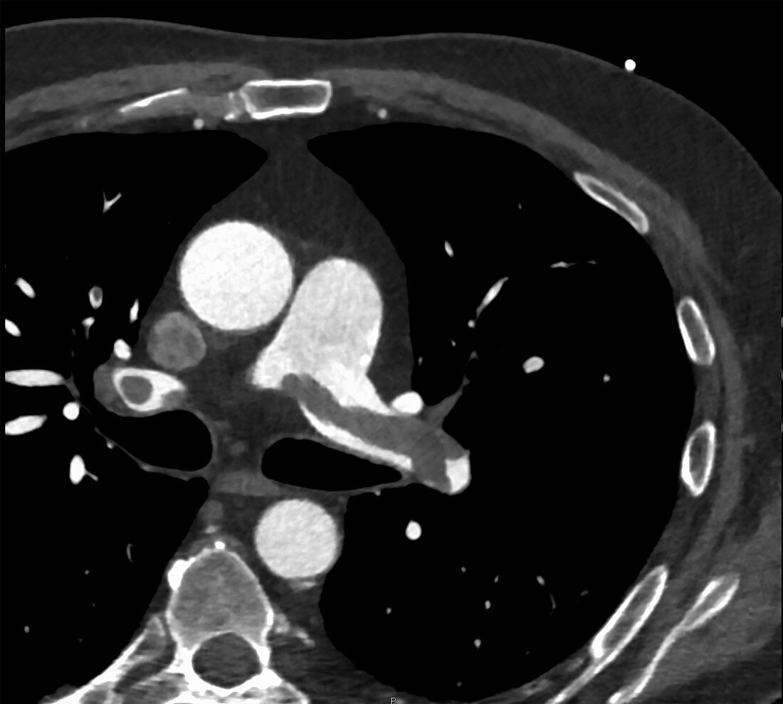 Pulmonary thromboembolism, CT angiogram