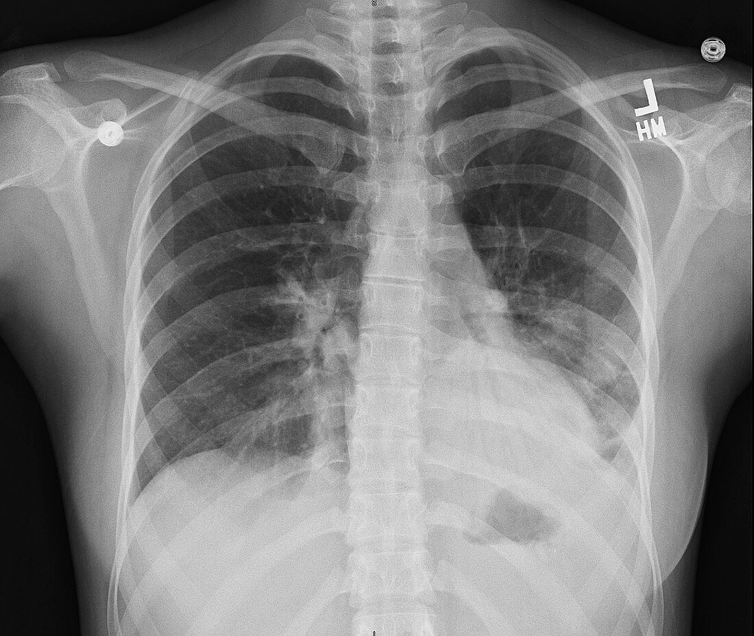 Lower left lobe infiltrate, X-ray