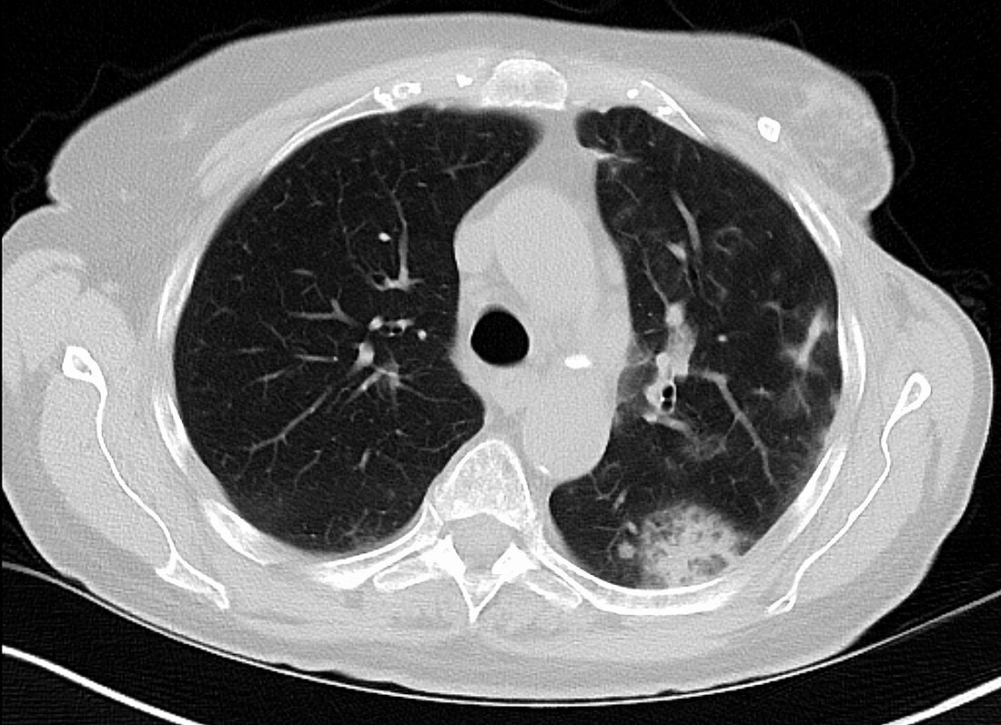 Eosinophilic pneumonia, CT scan