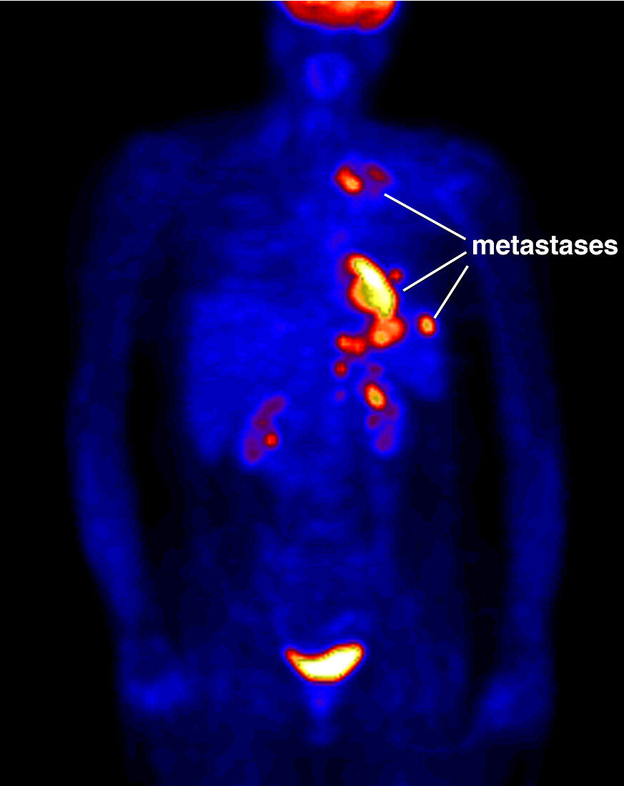 Lung carcinoma, PET scan
