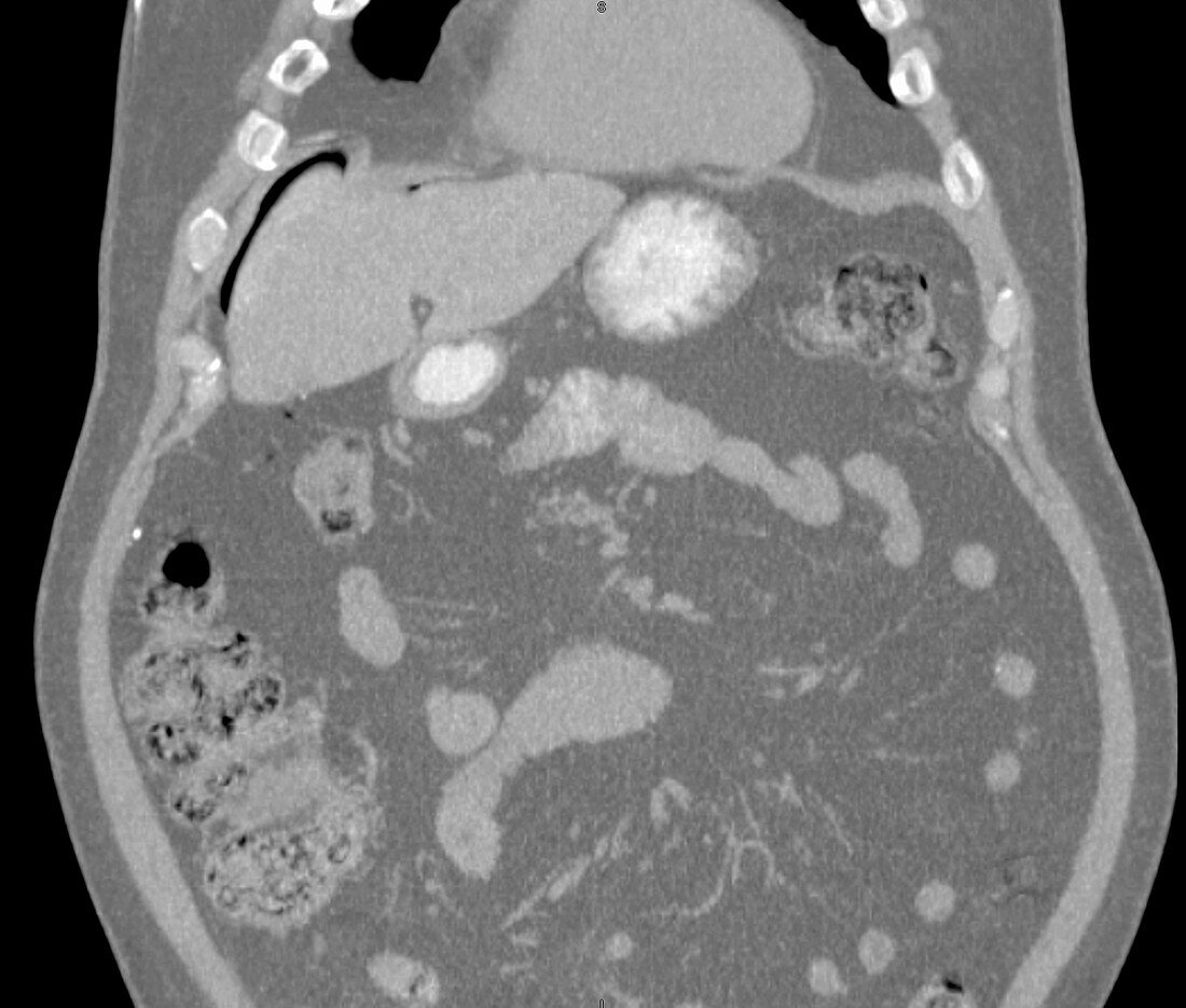 Pneumoperitoneum, coronal CT scan