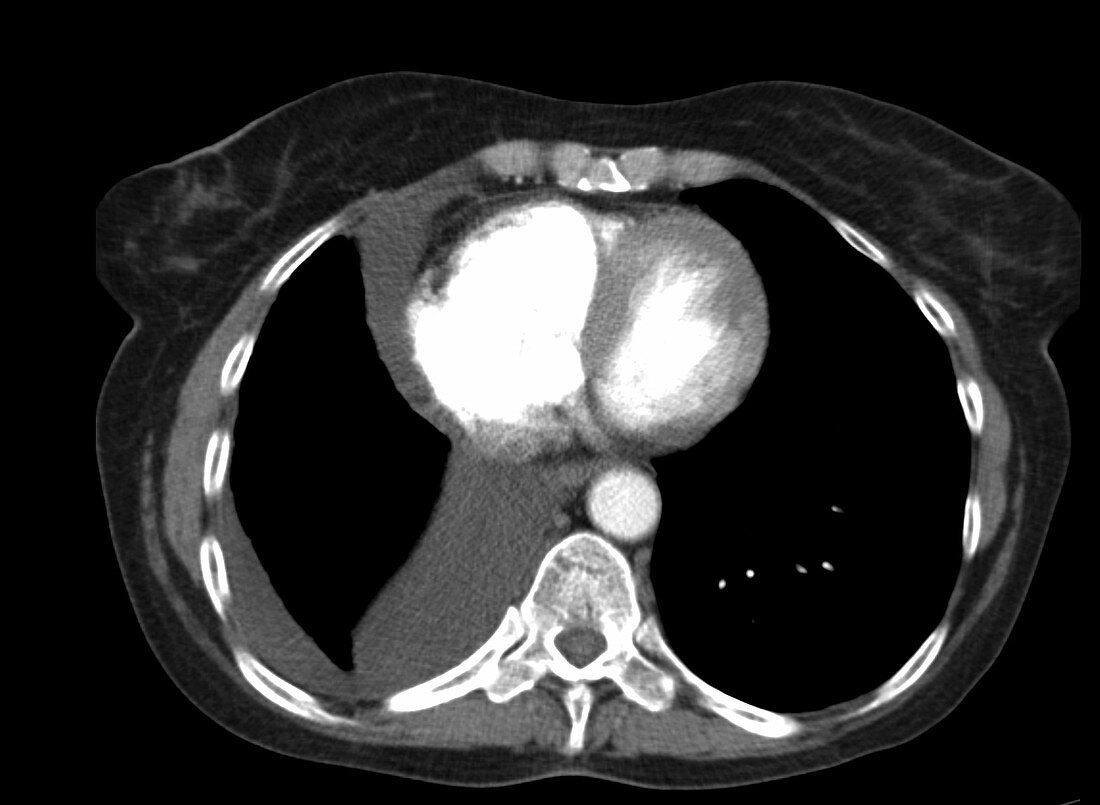 Pleural effusion, CT scan