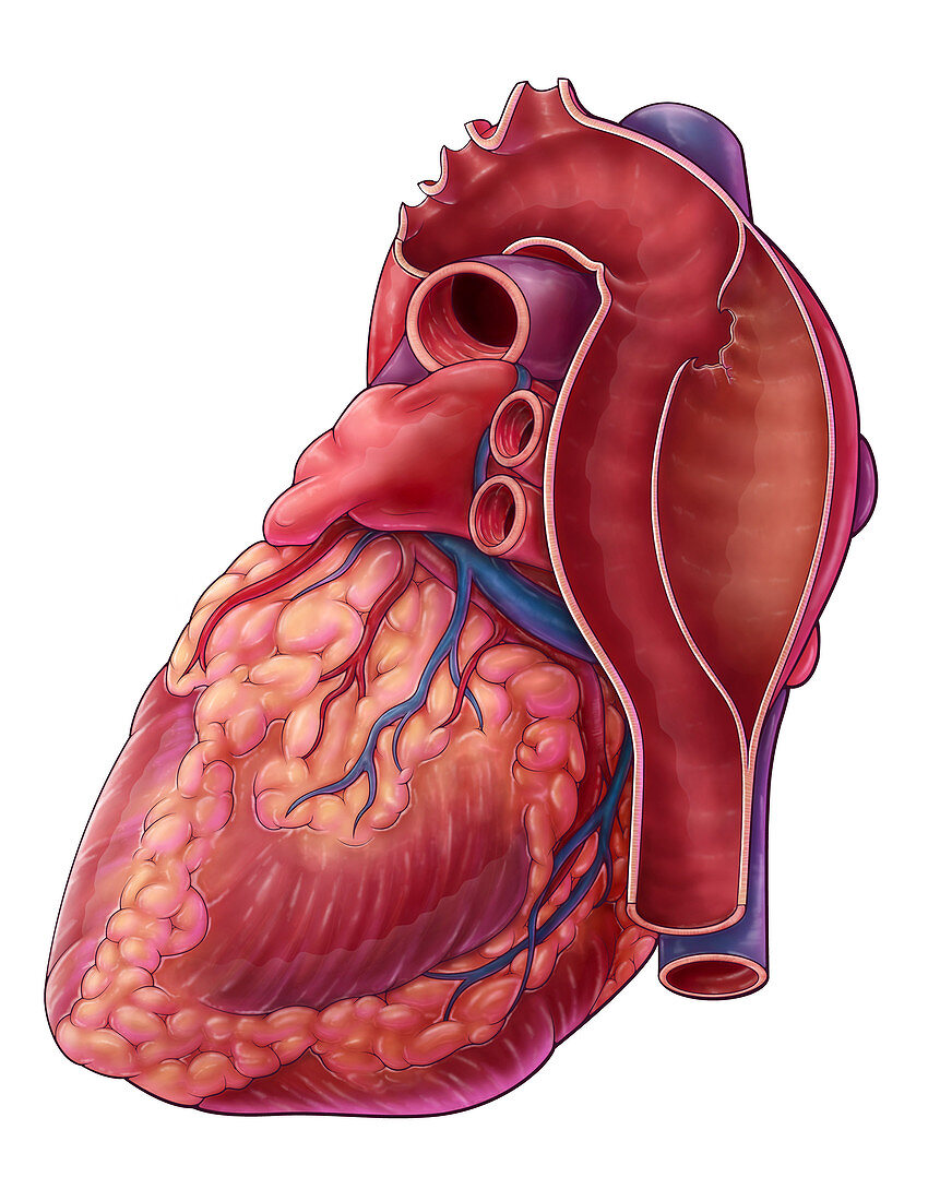 Aortic Dissection, Illustration