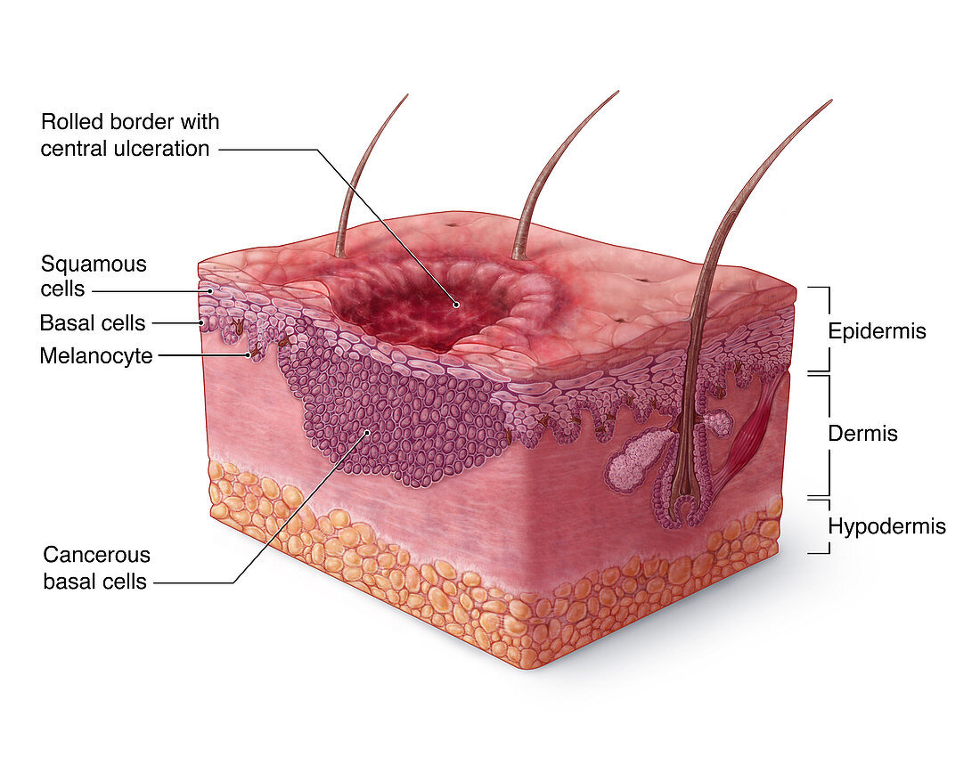 Basal Cell Carcinoma Illustration