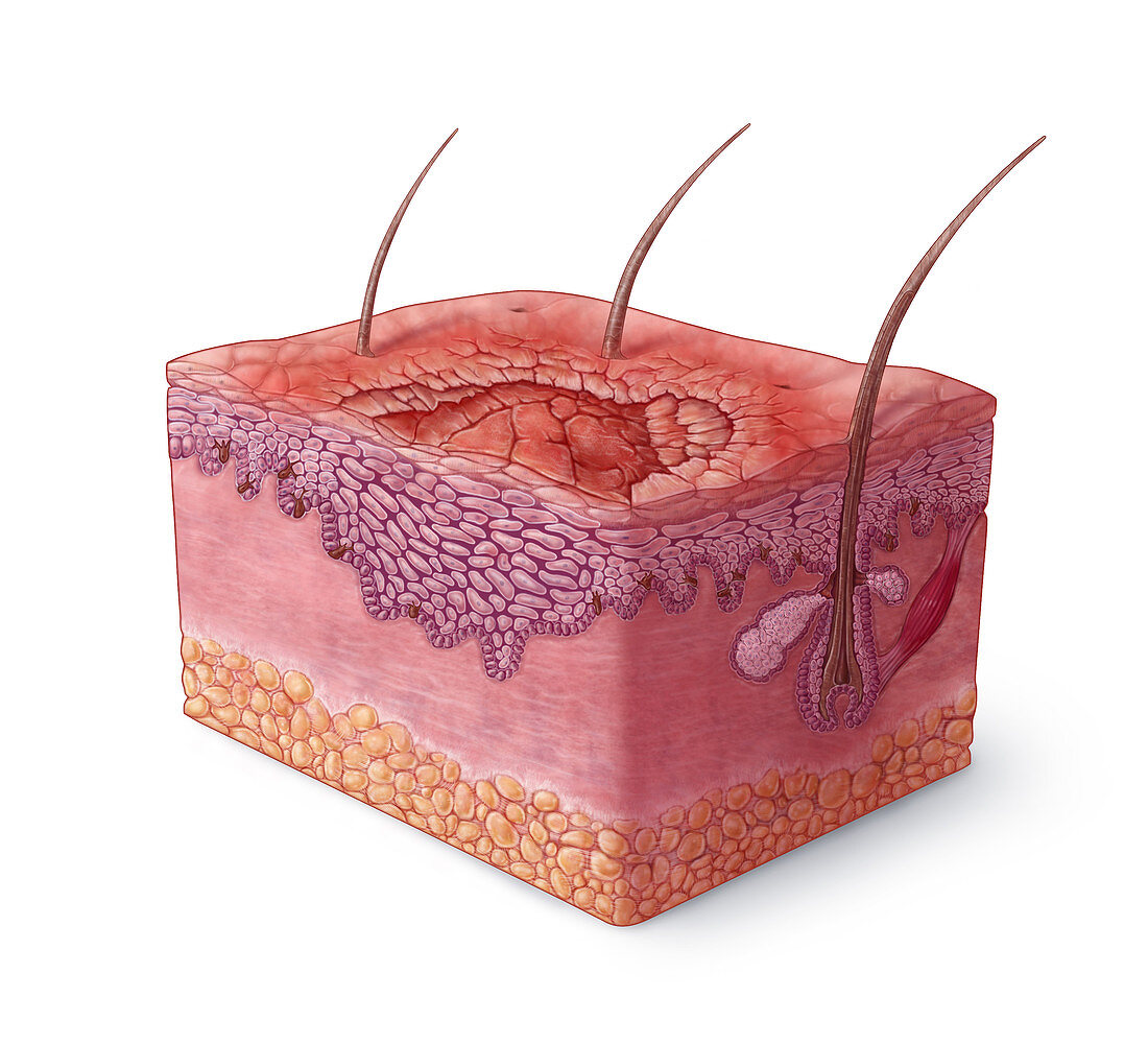 Squamous Cell Carcinoma Illustration