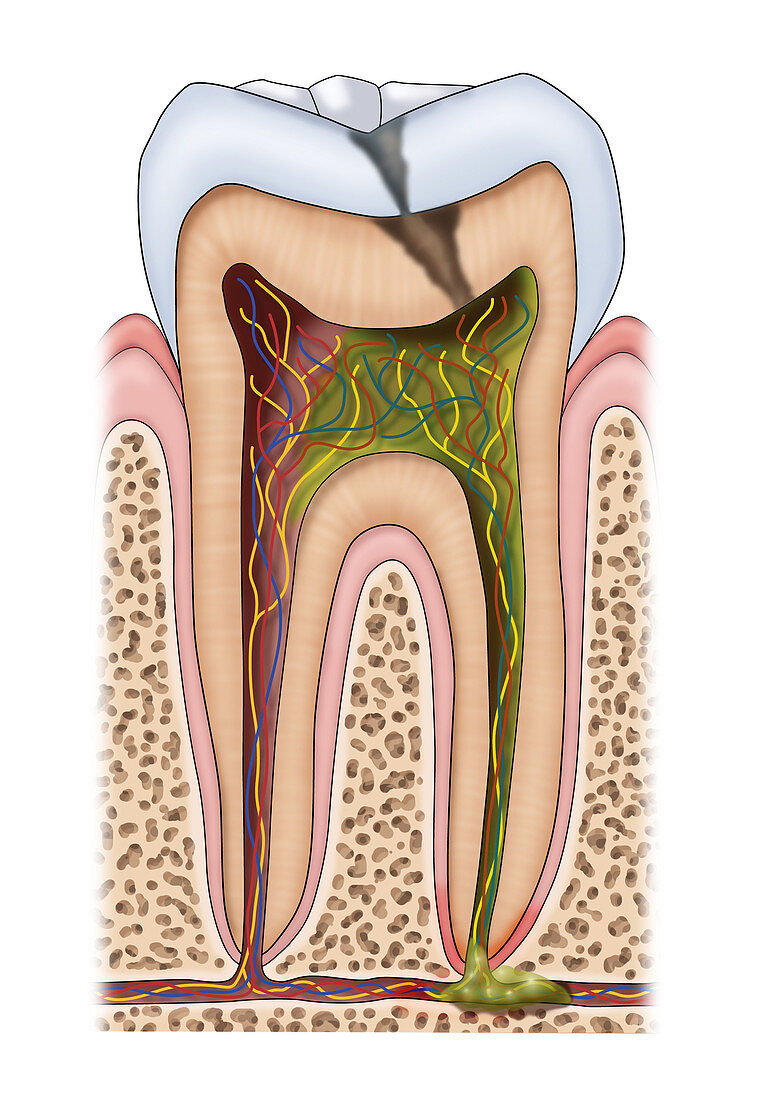 Dental Cavity and Abscess, Illustration