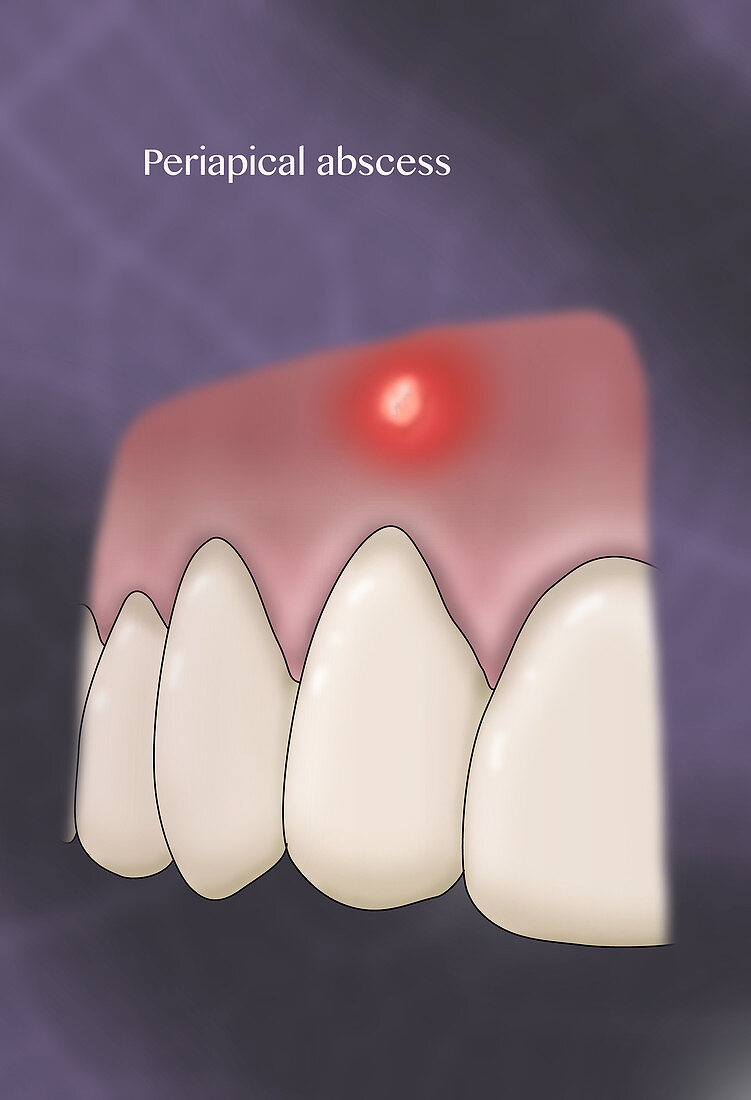 Periapical Abscess, Illustration