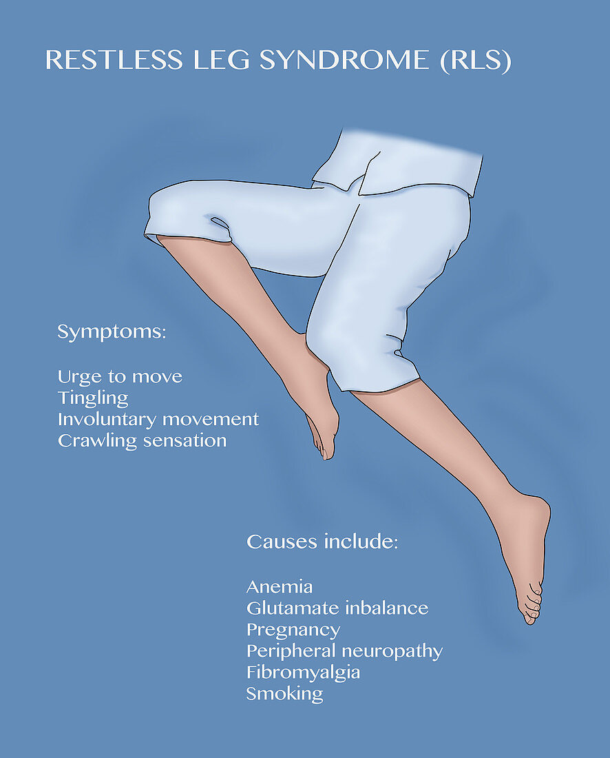 Restless Leg Syndrome, Illustration