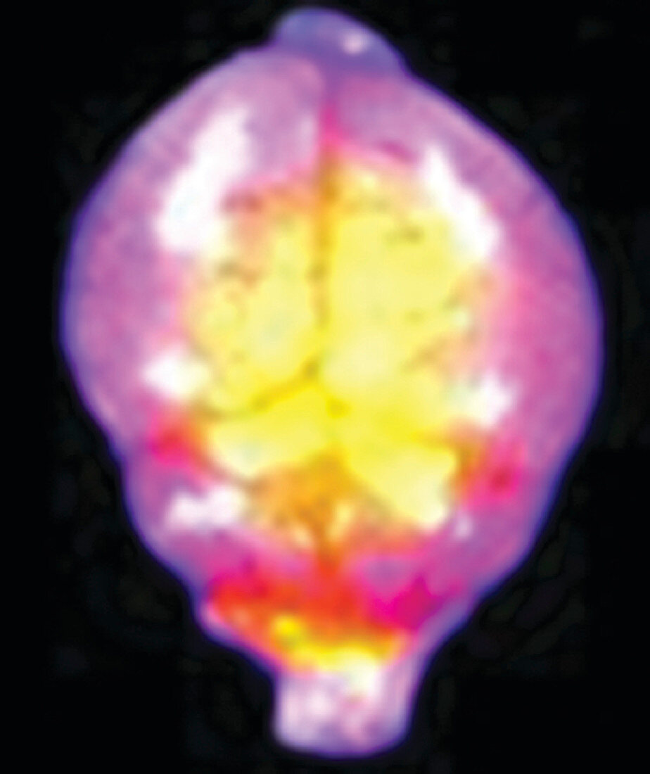 Nanoparticles as experimental brain cancer treatment