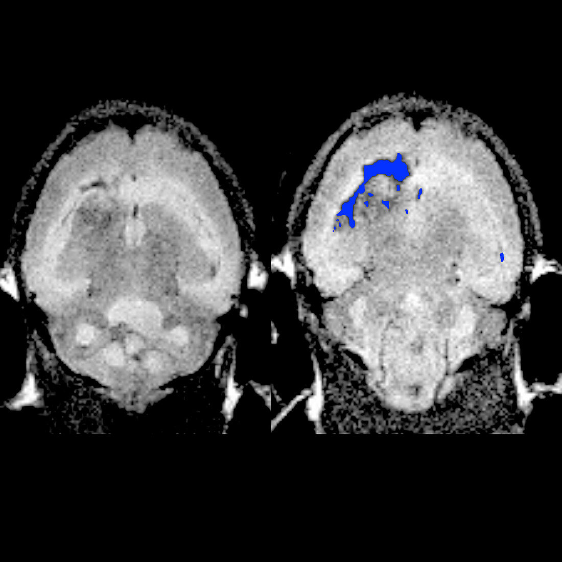 Targeted nanochains in brain cancer, MRI scans