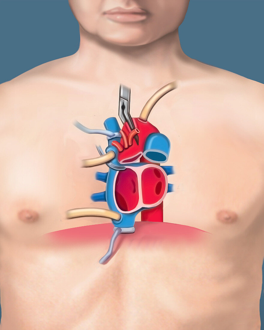 Transplant recipient heart removal, illustration