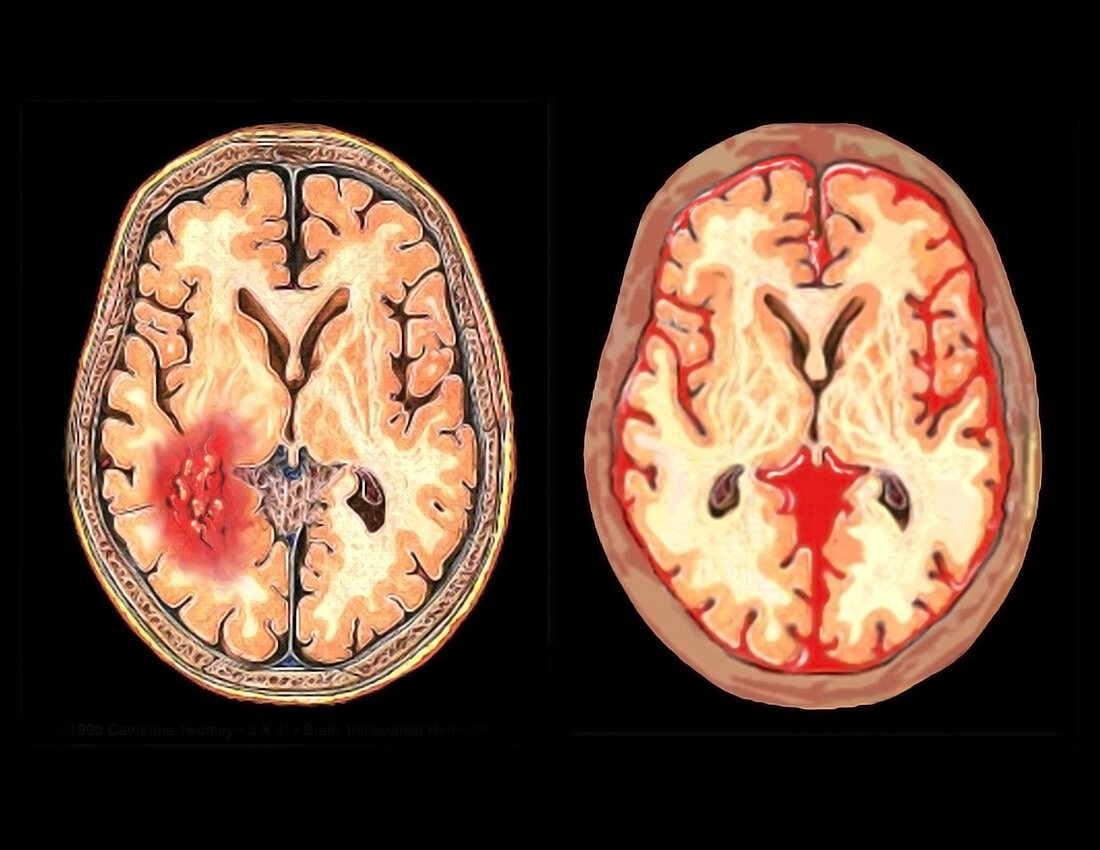 Brain, subarachnoid haemorrhage, subdural hematoma