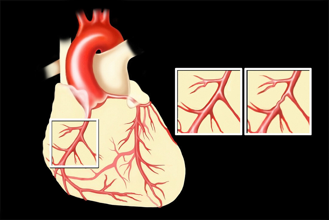 Heart, normal vs. coronary artery disease vessels