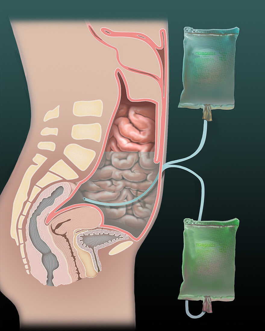 Dialysis, illustration