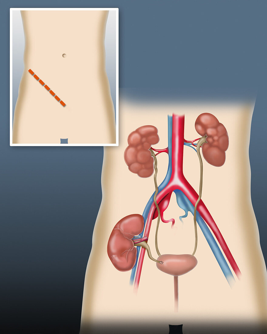 Kidney transplant, illustration
