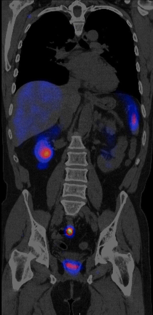 Carcinoid, coronal CT scan