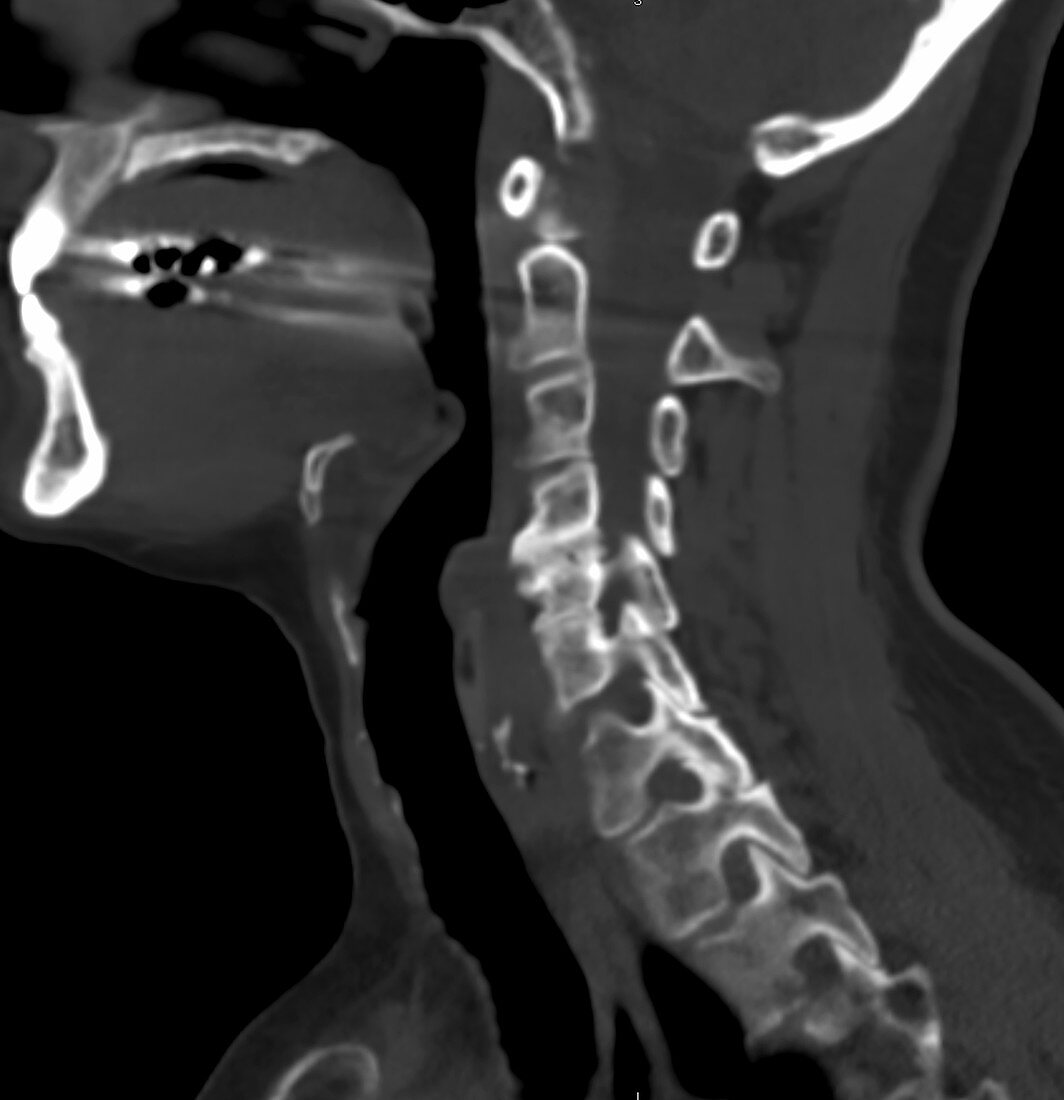 Chicken bone in esophagus, CT scan