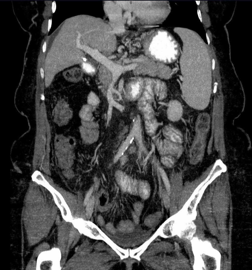 Cirrhosis, coronal CT scan