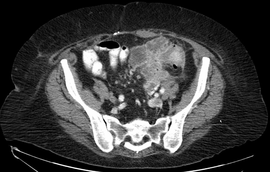 Colon perforation, CT scan