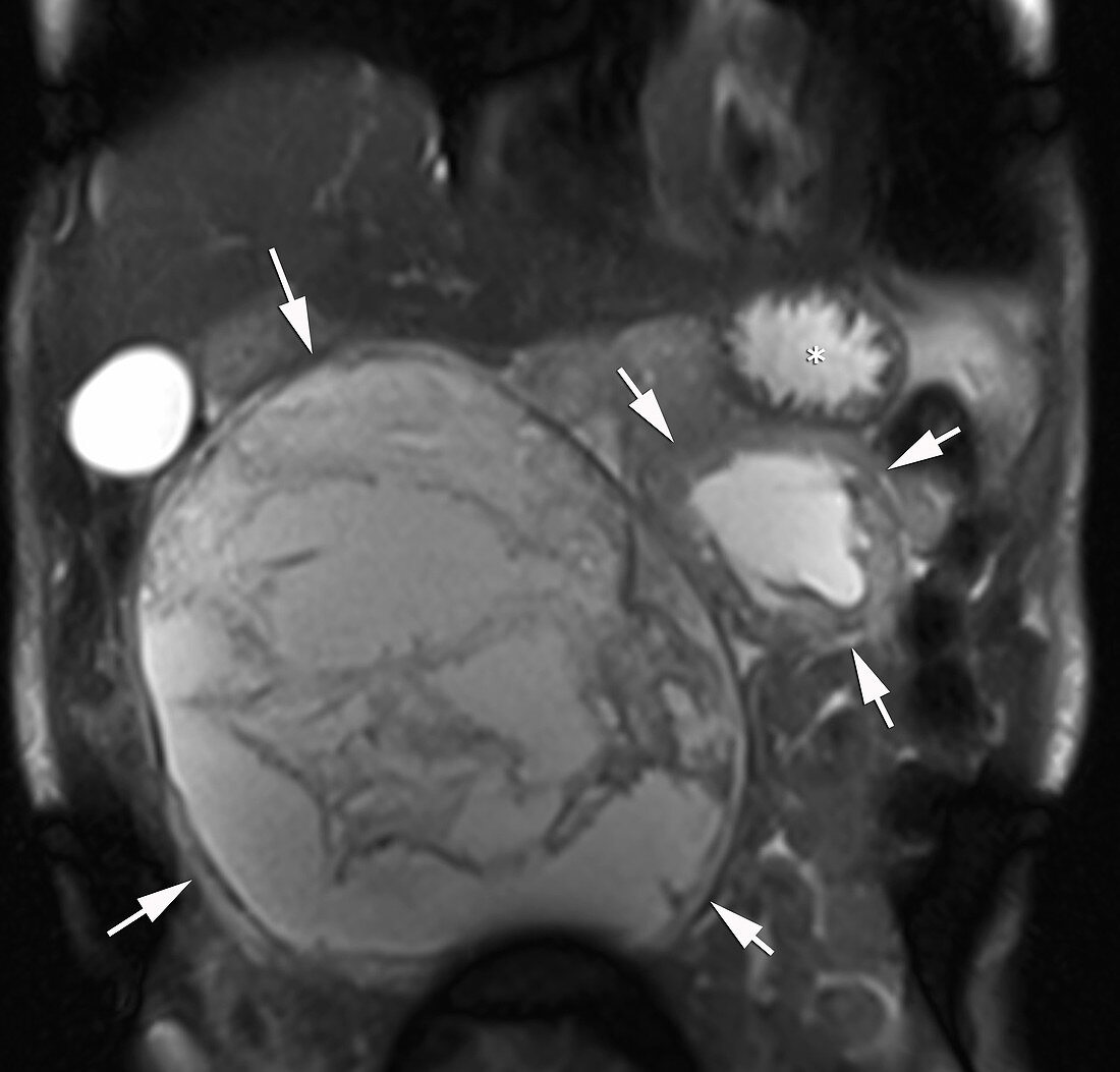 Gastrointestinal stromal tumour, MRI