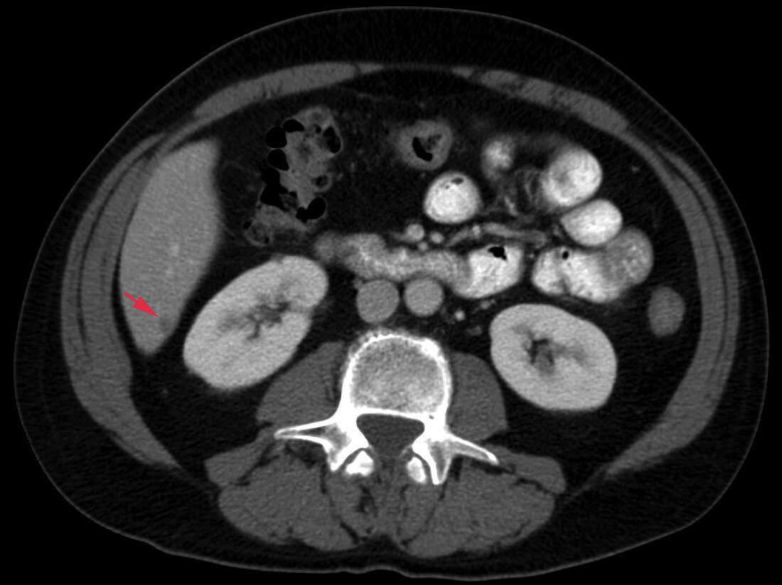 Liver metastases, CT scan