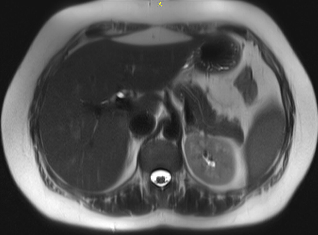 Normal pancreas, MRI