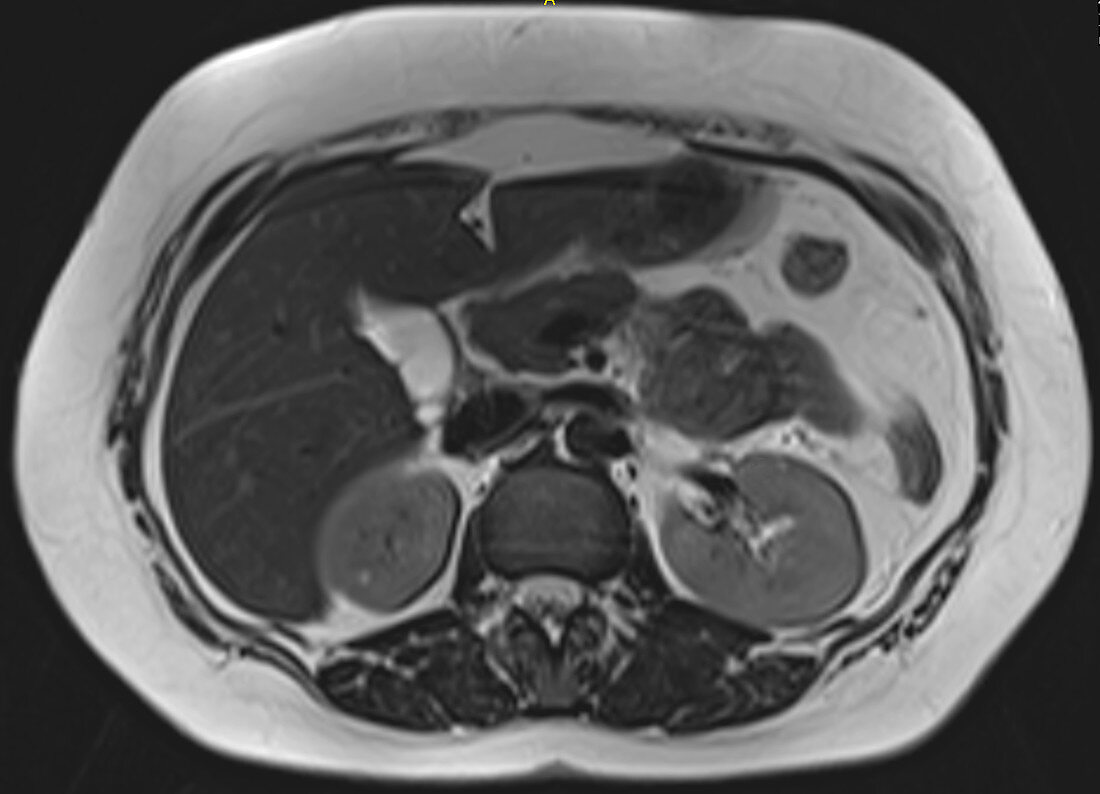 Normal pancreas, MRI