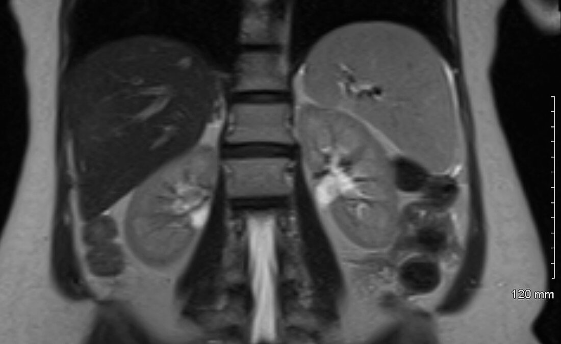 Enlarged spleen, MRI