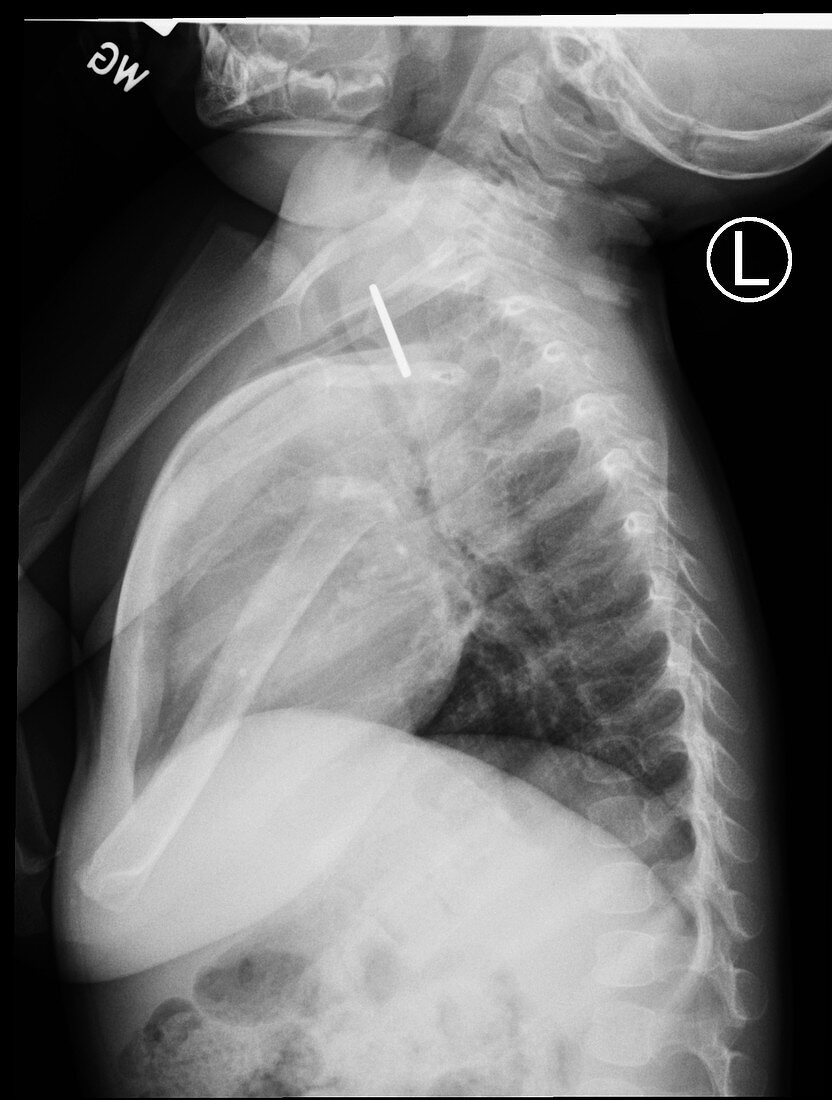 Coin in child's esophagus, X-ray