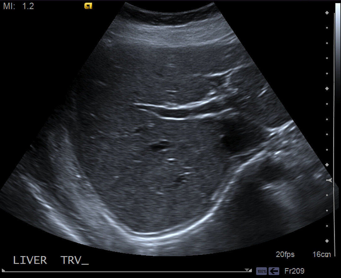 Normal liver, ultrasound