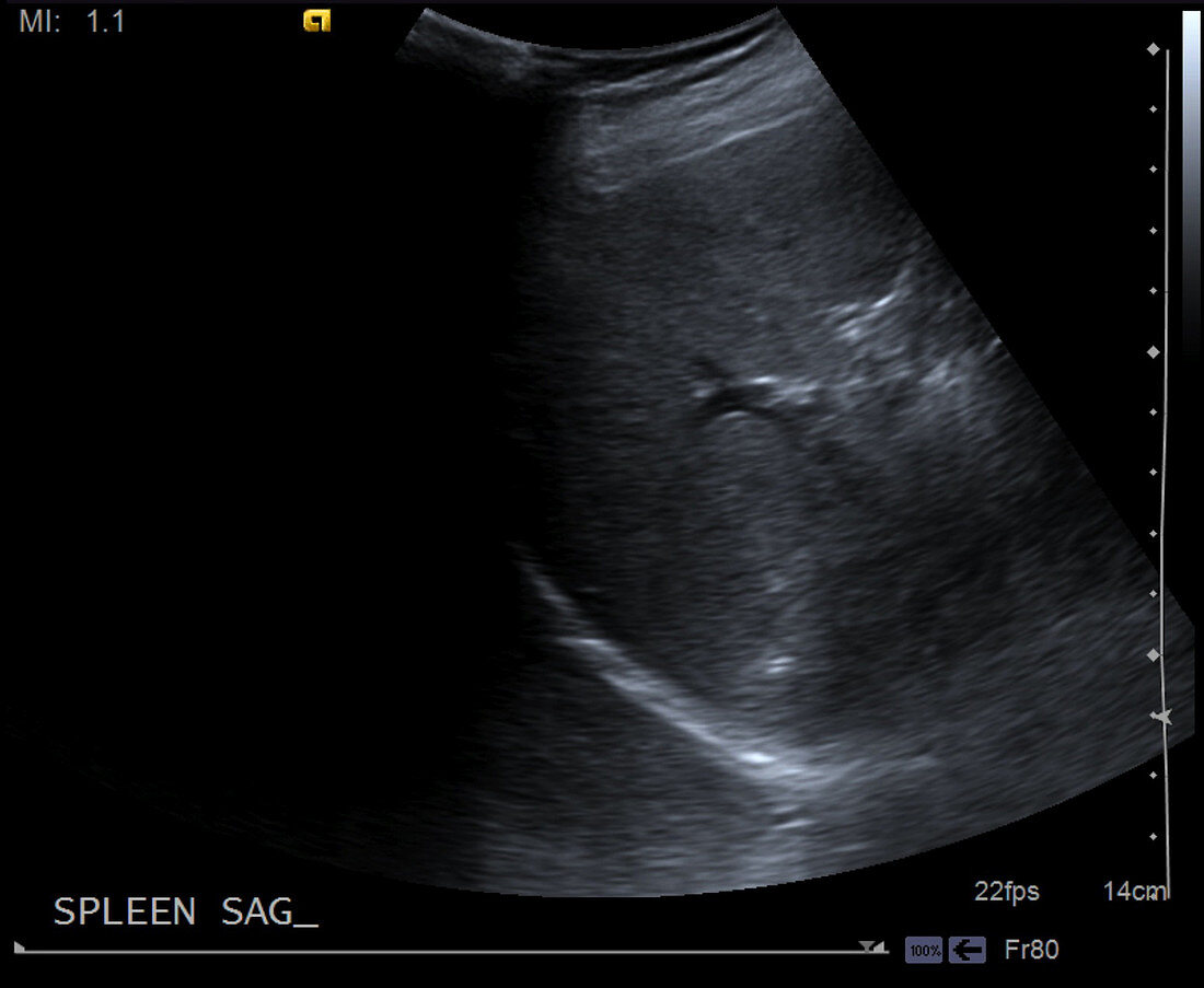 Normal spleen, ultrasound