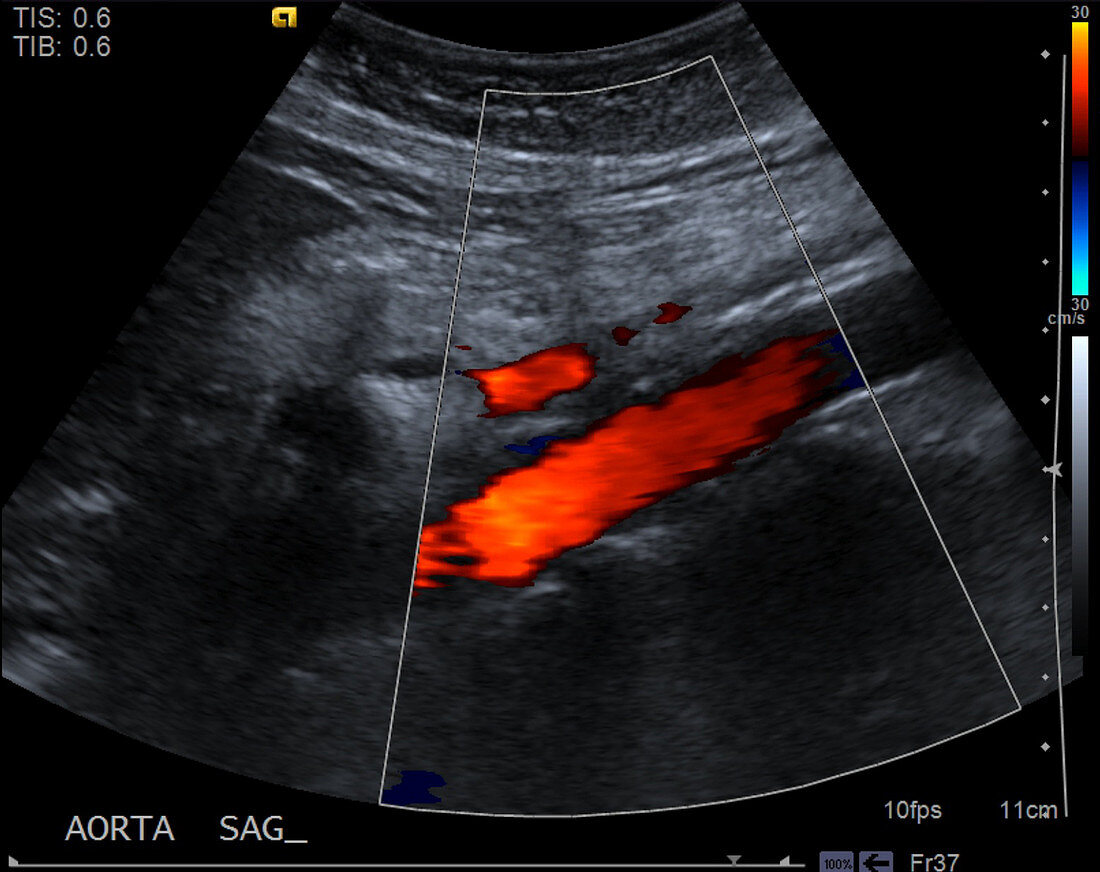 Normal aorta, ultrasound
