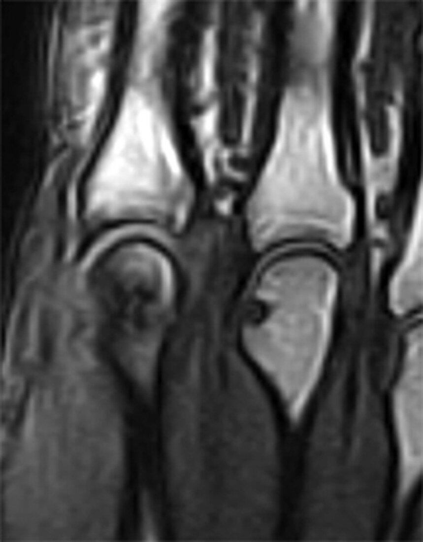 Metacarpal head erosion, MRI